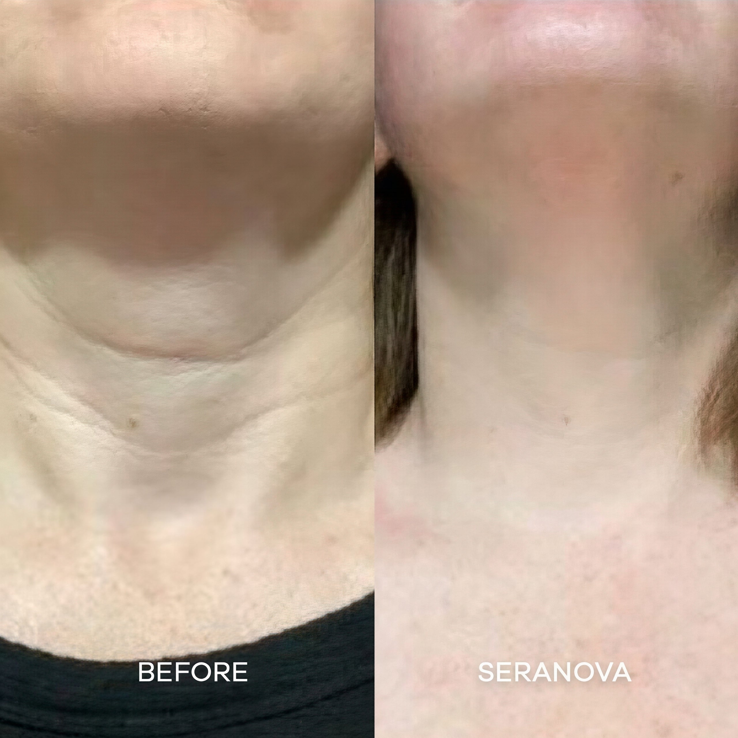 Seranova Micro Infusion Hyaluronic Acid Collagen Peptide 3 Month Supply