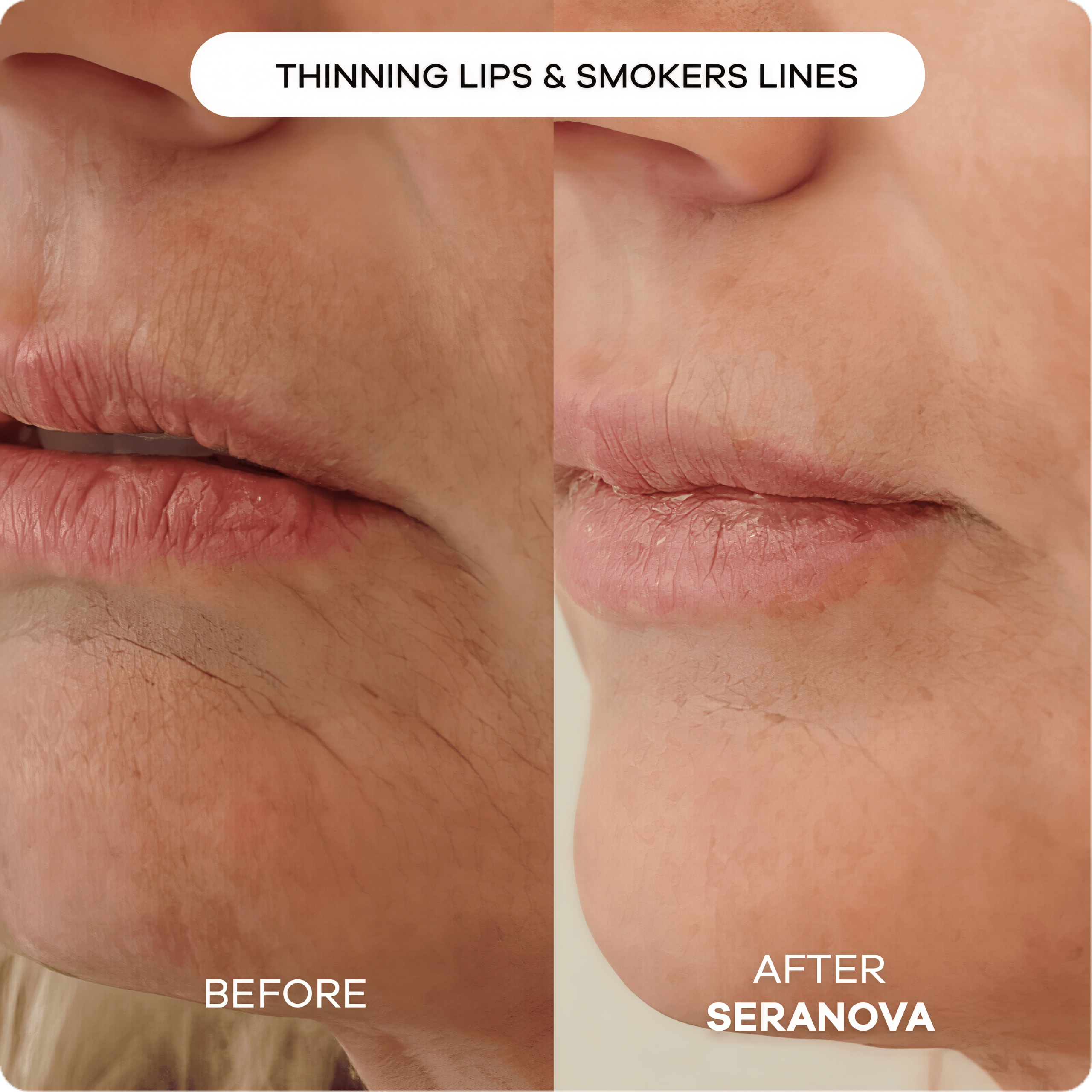 Seranova Micro Infusion Hyaluronic Acid Collagen Peptide 3 Month Supply