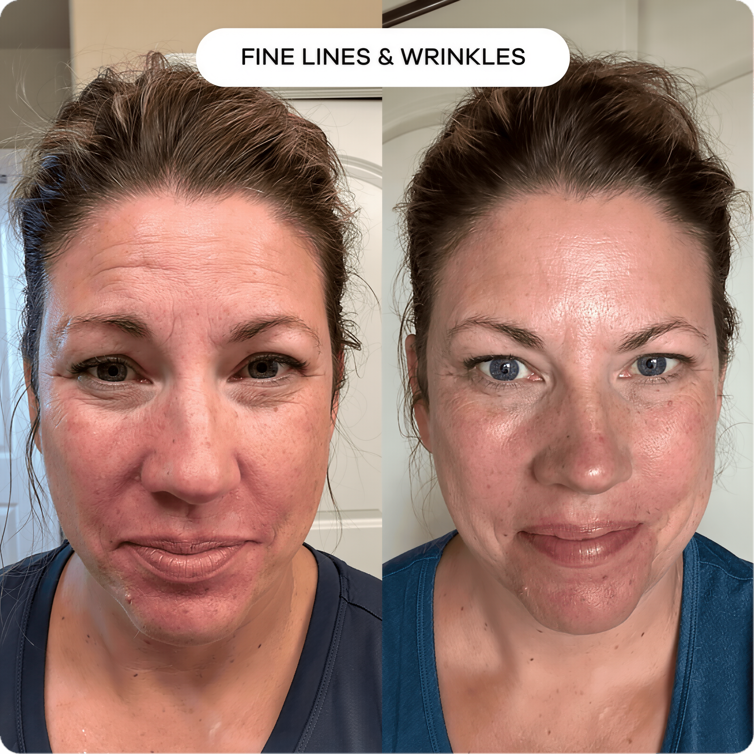 Seranova Micro Infusion Hyaluronic Acid Collagen Peptide 3 Month Supply